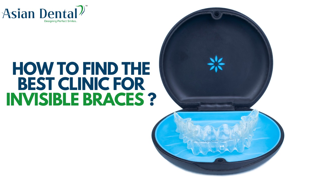 Invisible Braces for All Ages: How to Find the Best Dental Clinic for ...