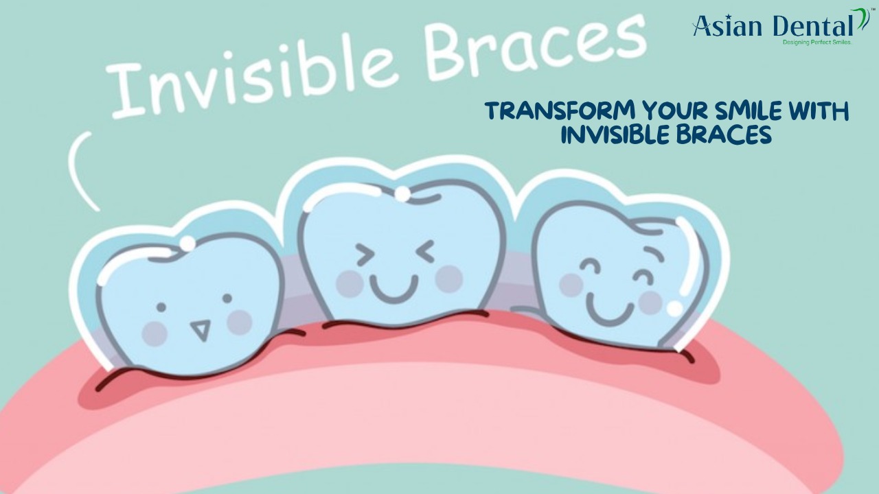 Transform Your Smile With Invisible Braces In Hyderabad Asian Dental