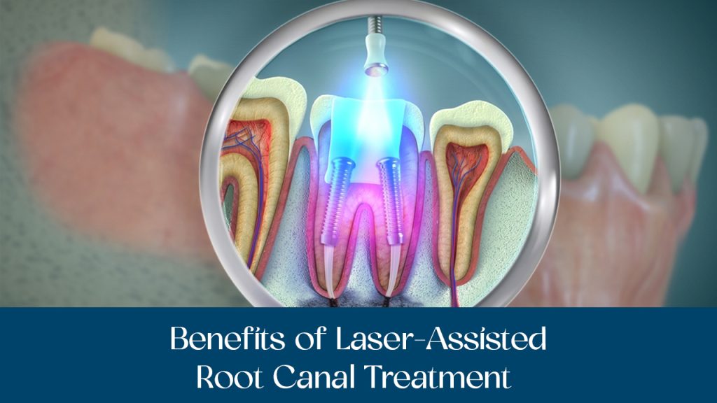 advantages of laser assisted root canal treatment