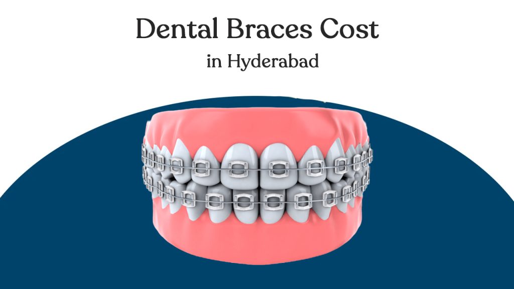 dental-baces-cost-in-hyderabad