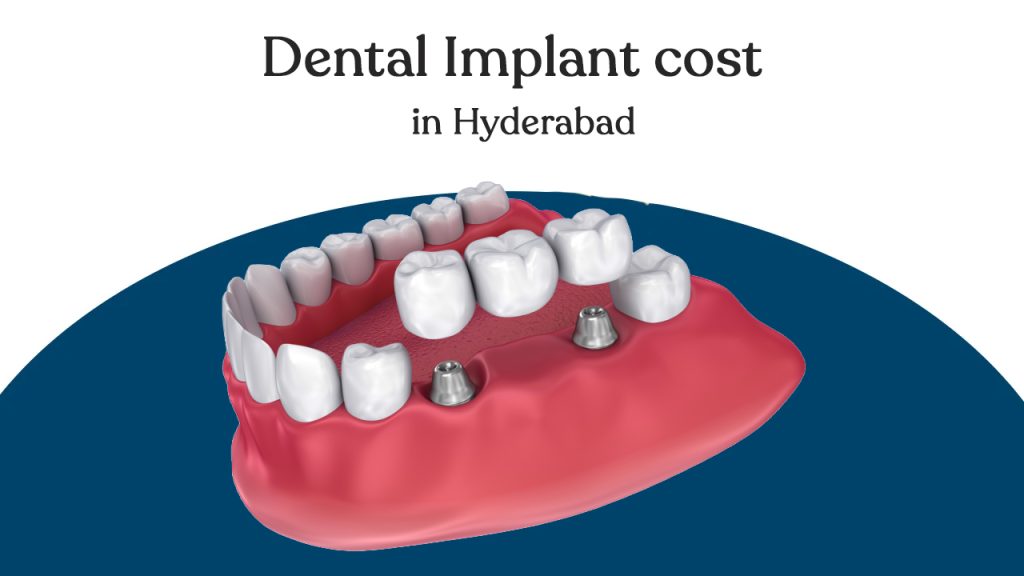 dental implant cost in hyderabad