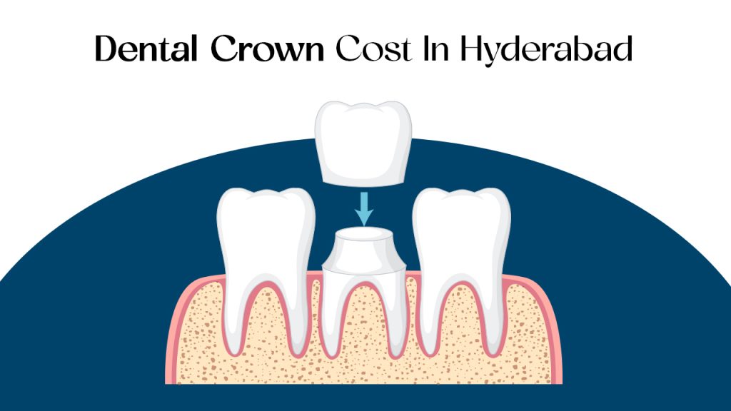 dental crown cost in hyderabad