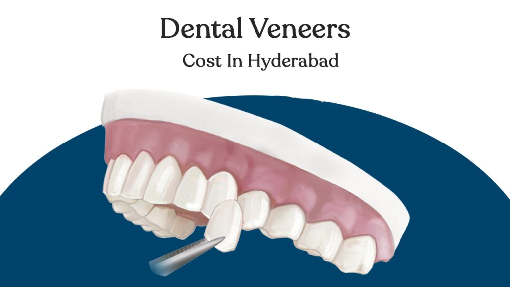 dental veneers cost in hyderabad