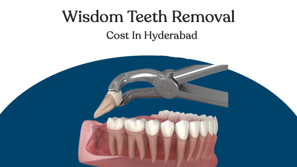 wisdom tooth removal cost hyderabad