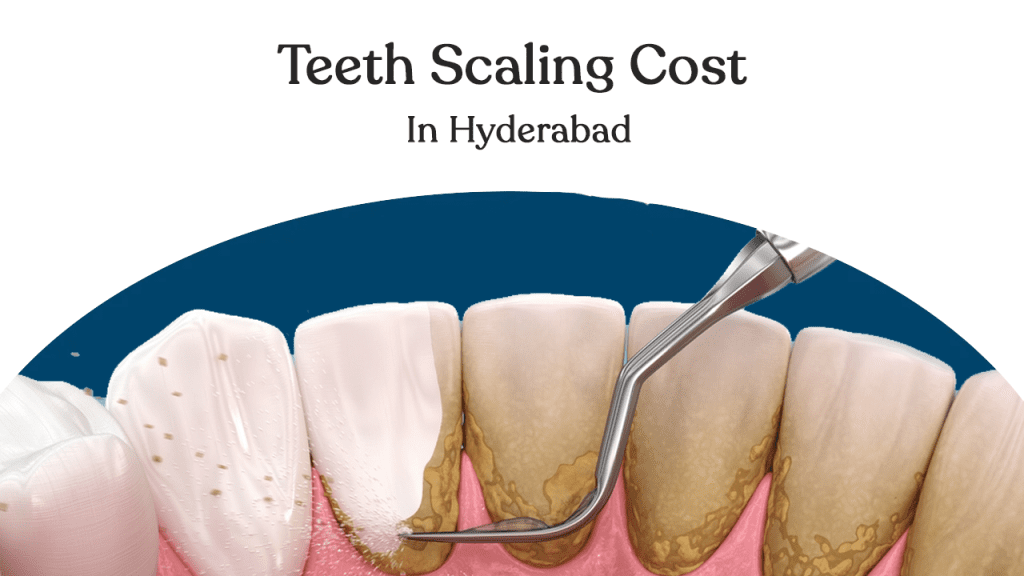 teeth scaling cost in hyderabad