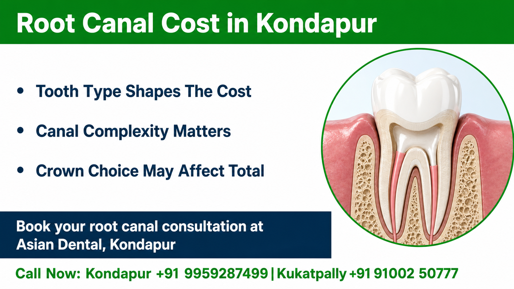 Infographic chart showing root canal price drivers: tooth type, number of canals, infection level, advanced microscope or laser use, and restoration needs