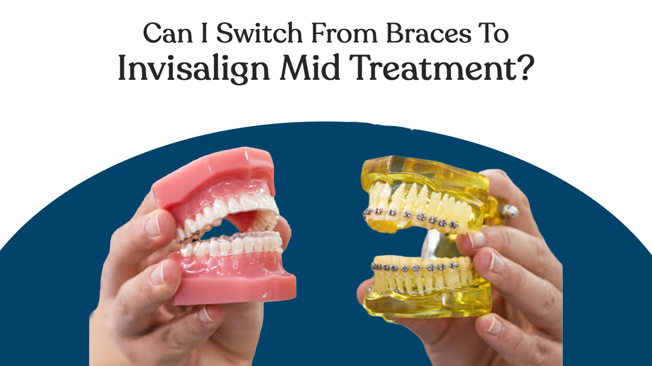 can i switch from braces to invisalign