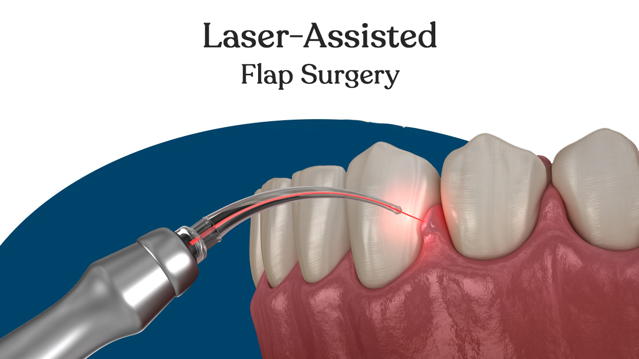 Steps for Laser Gum Surgery