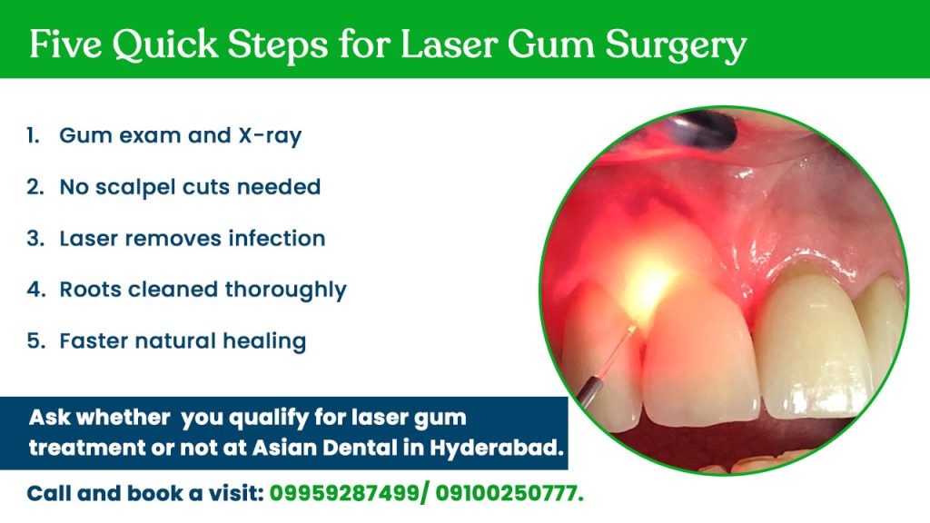 Steps for Laser Gum Surgery