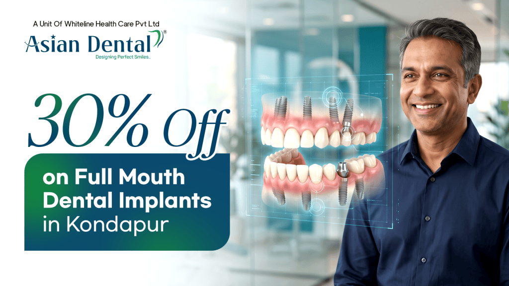 full mouth dental implants in Kondapur